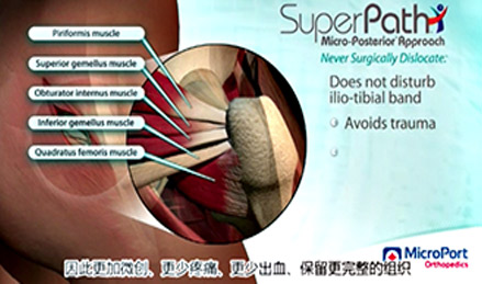 SuperPATH<sup>®</sup>, SuperCap<sup>®</sup>, Path<sup>®</sup>手术入路